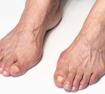 bunions