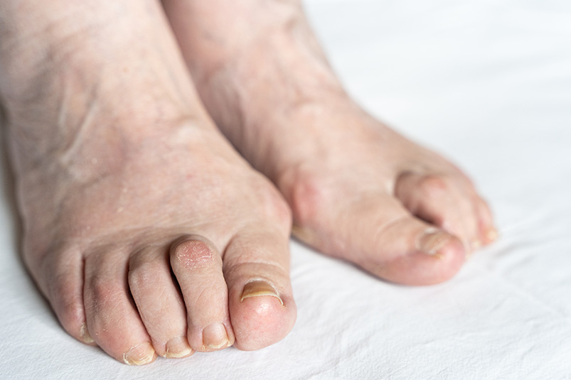 Bunions Treatment: Accommodative vs. Correctional Approaches